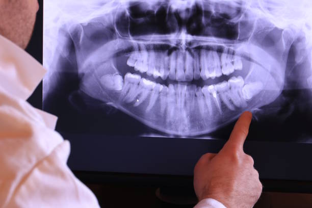 Best Emergency Dental Care for Broken or Chipped Teeth in Mount Pulaski, IL