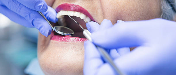 Best Emergency Wisdom Teeth Removal in Mount Pulaski, IL